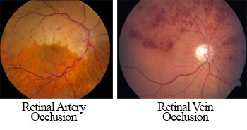Retinal Vascular Occlusions