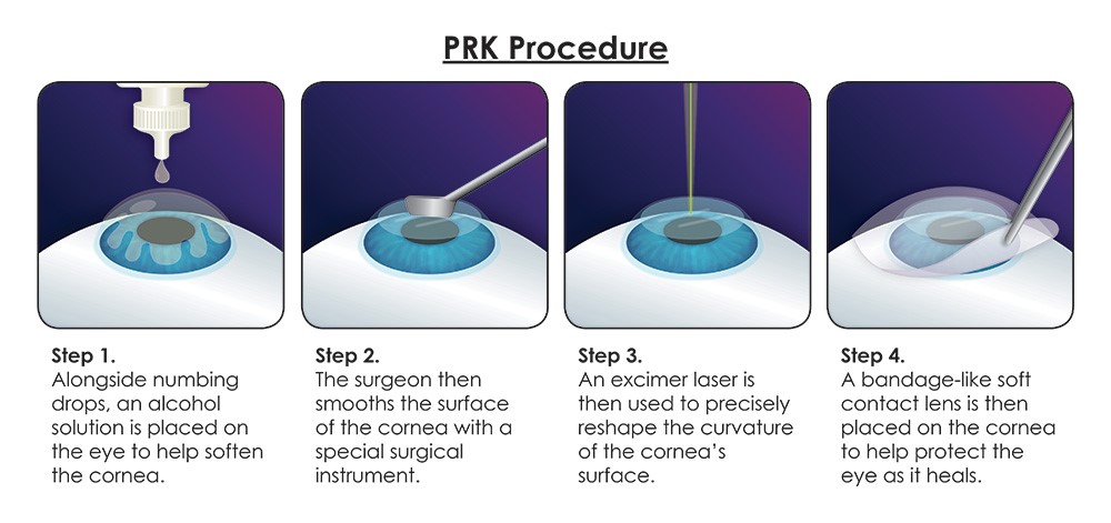 PRK Procedure