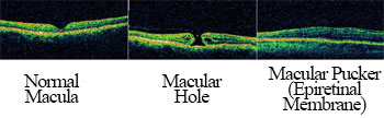 Macular Holes and Puckers